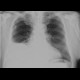 Hydrothorax, pleural effusion: X-ray - Plain radiograph